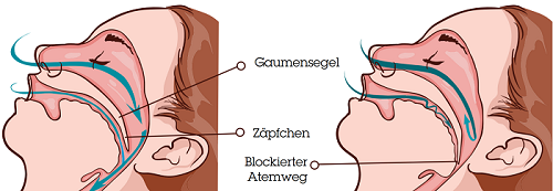 Normale Atmung vs. Obstruktive Schlafapnoe